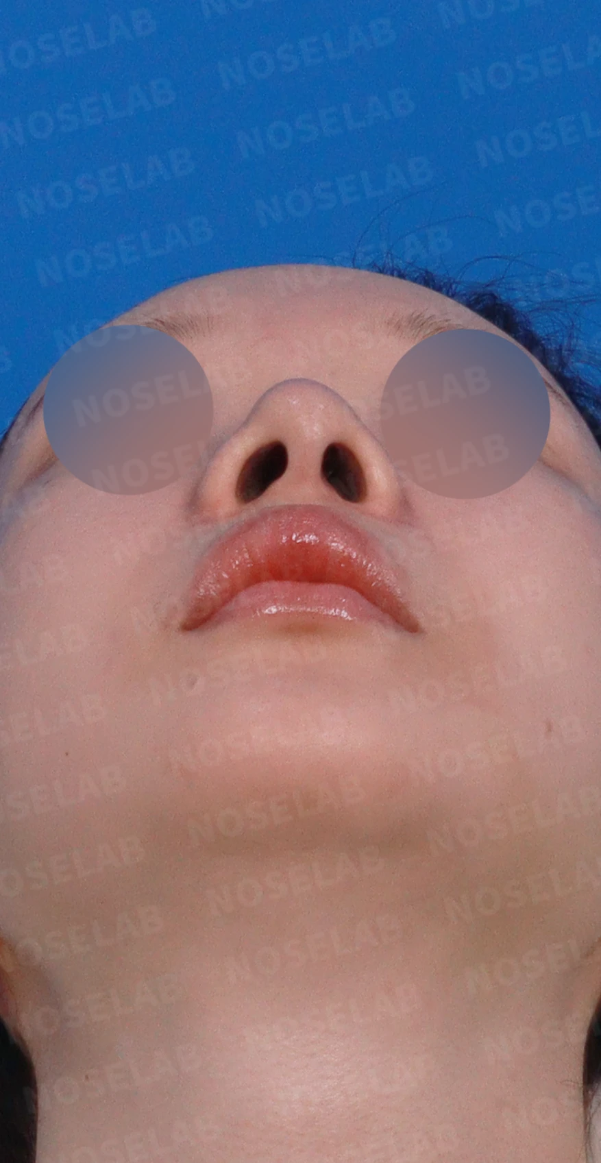 절골 부위가 과하게 깎이면 코가 왜 휘어 보이는가, 코뼈 복원과 코끝 재건 — 디자인 상담 우측 측면, 비스듬한 측면, 비공 사진입니다.