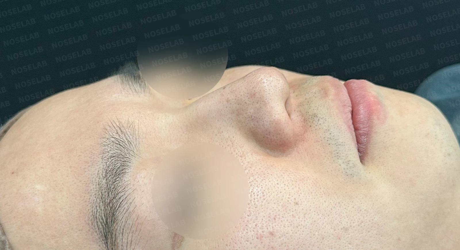 복코와 퍼진 코의 코성형 방법 — 수술 전 / 수술 직후 0일 직후 사진은 부기가 있는 상태로 최종 결과와 다를 수 있습니다.
