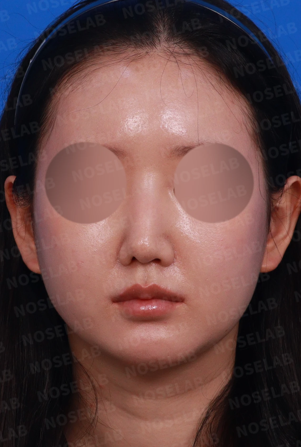 비공 비대칭과 코끝 처짐은 왜 생기나, 연골을 병용한 재건 방법 — 디자인 상담 정면, 좌측 측면, 비스듬한 측면 사진