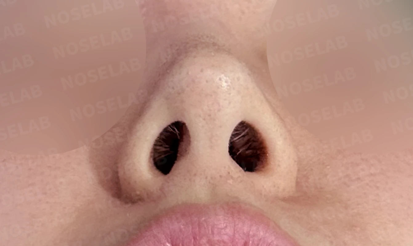 코가 길어 보이고 비주가 휘는 이유, 비중격 연장과 재건은 어떻게 하나 — 수술 전 / 수술 직후 0일 직후 사진은 부기가 있는 상태로 최종 결과와 다를 수 있습니다.