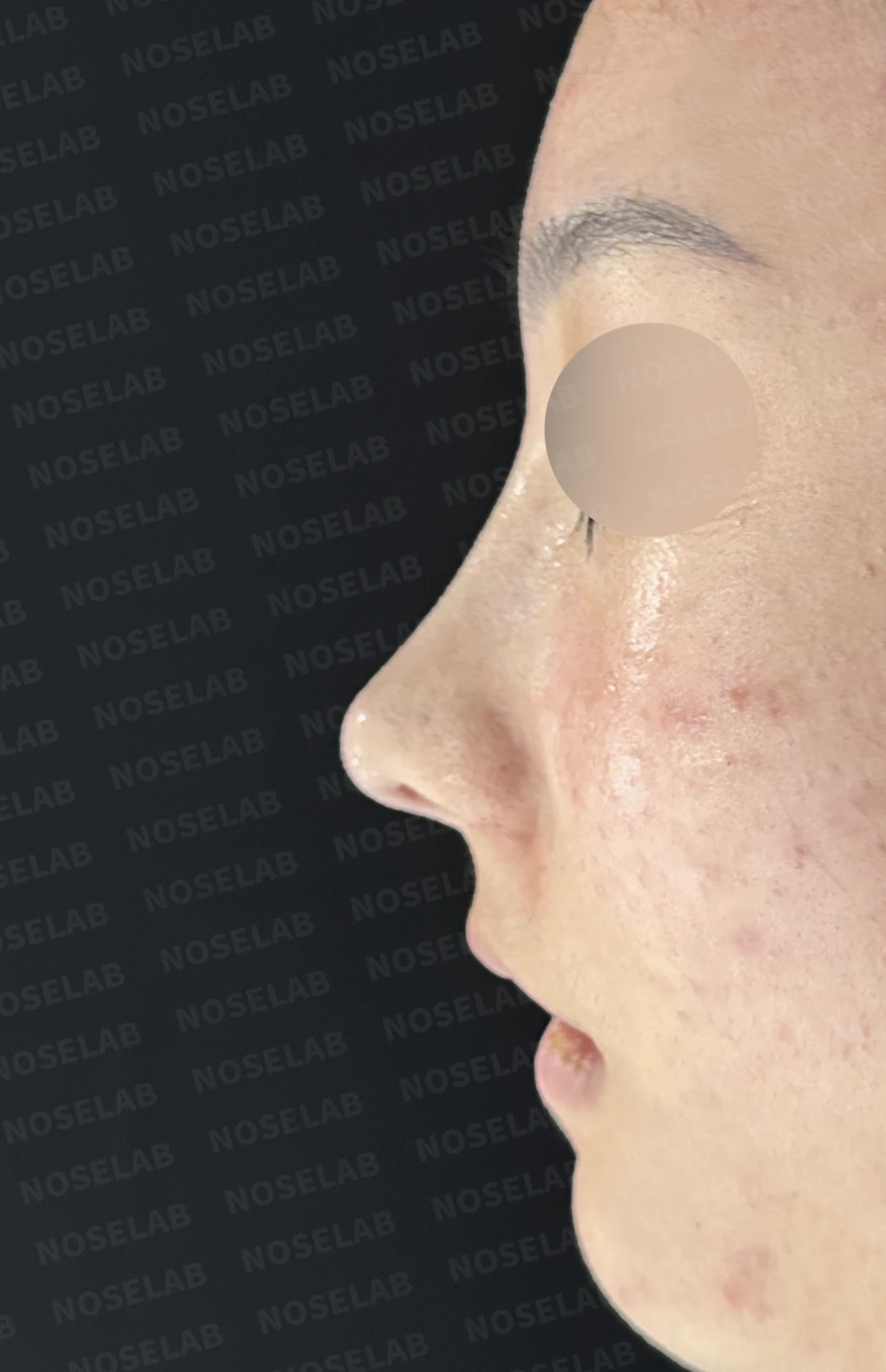 콧대가 낮고 코끝이 뭉툭해 보이는 이유, 함몰된 비주와 함께 교정하는 방법 — 수술 직후 0일 정면, 비스듬한 측면, 측면 사진입니다. 직후 사진은 부기가 있는 상태로 최종 결과와 다를 수 있습니다.