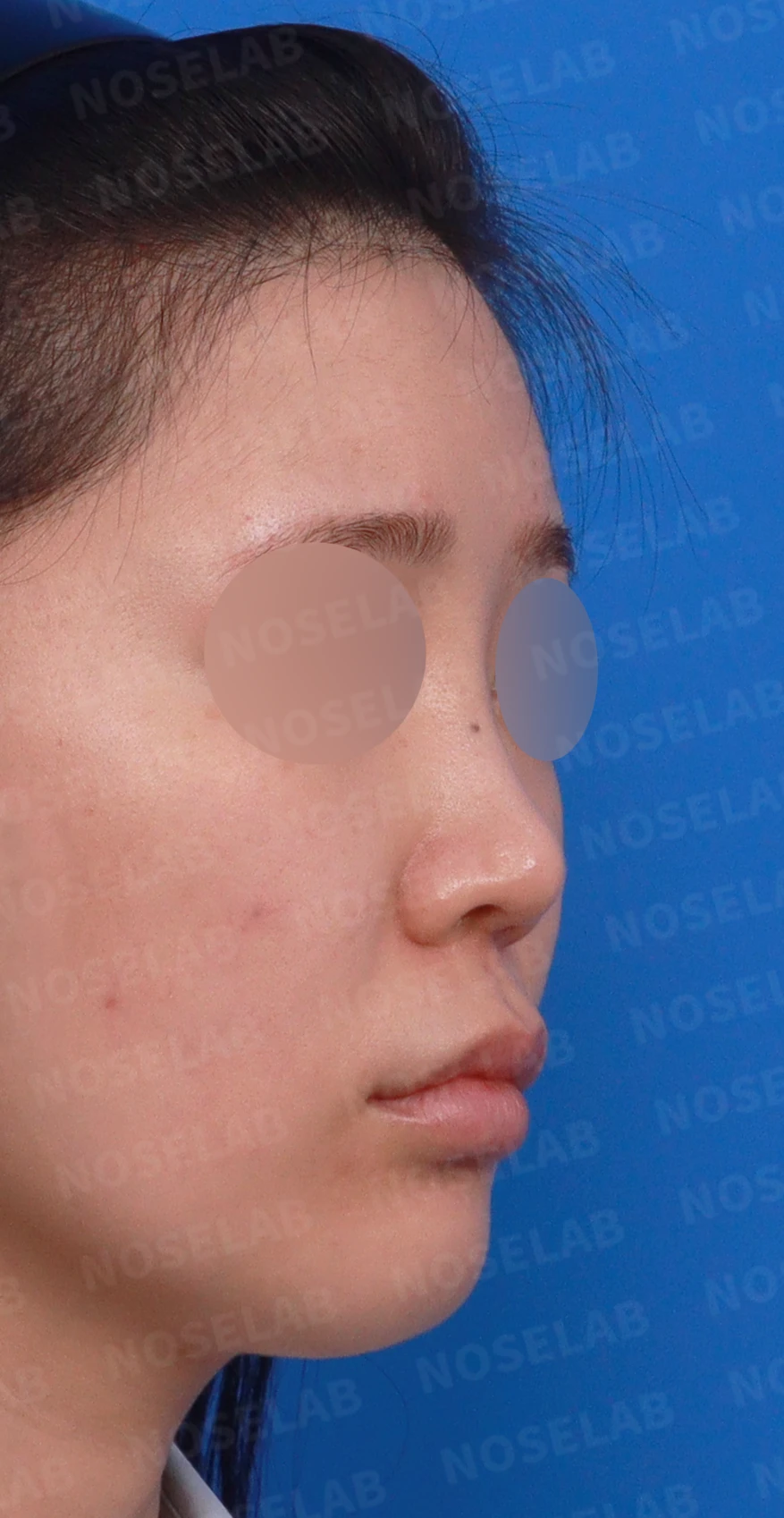 연골 노출 복원과 날개 연골 재건으로 안전하고 자연스러운 코 — 디자인 상담 우측 측면, 비스듬한 측면, 비공 사진입니다.