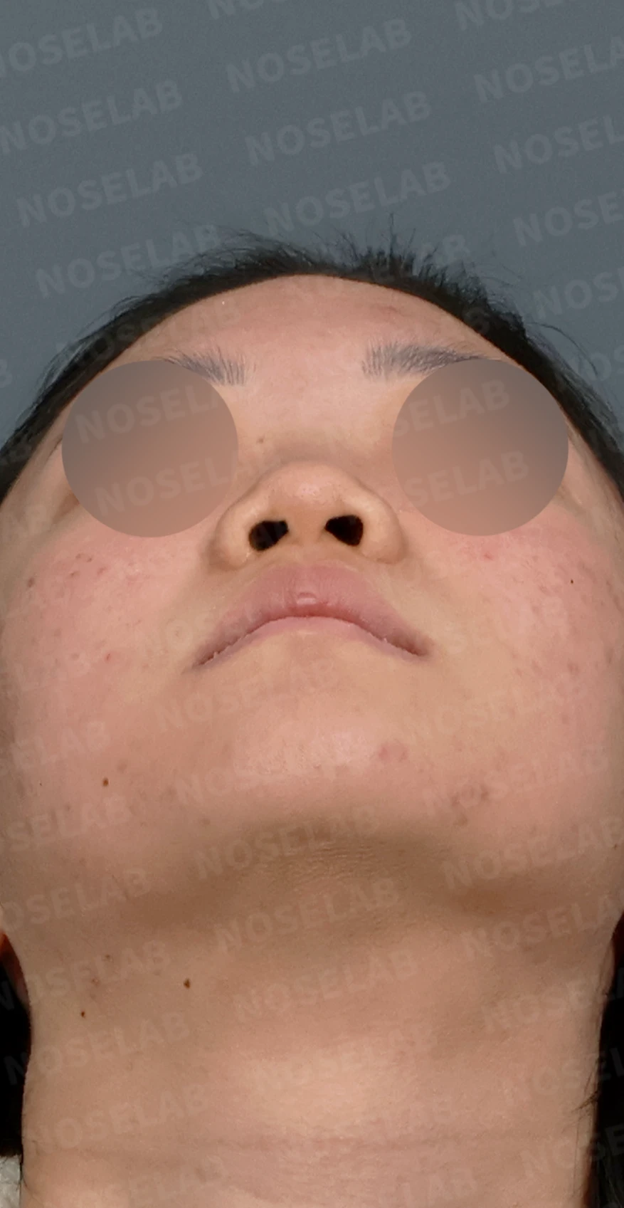 콧대가 낮고 코끝이 뭉툭해 보이는 이유, 함몰된 비주와 함께 교정하는 방법 — 디자인 상담 우측 측면, 비스듬한 측면, 비공 사진입니다.