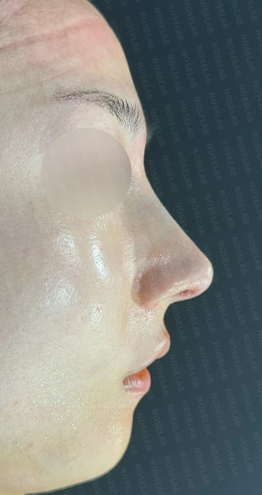 퍼진 코와 복코를 함께 교정하는 방법 — 수술 직후 0일 정면, 측면, 비스듬한 측면사진입니다. 직후 사진은 부기가 있는 상태로 최종 결과와 다를 수 있습니다.