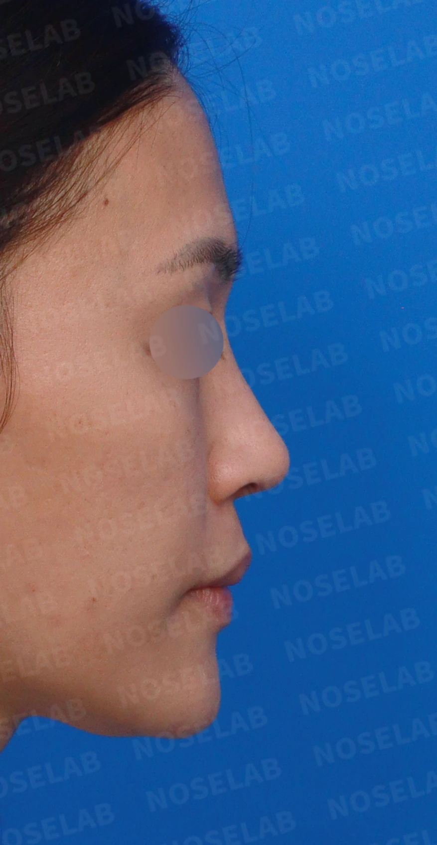 오래된 보형물 코의 코끝 지지력이 약해지는 이유와 비중격연장 재건 방법 — 디자인 상담 우측 측면, 비스듬한 측면, 비공 사진입니다.