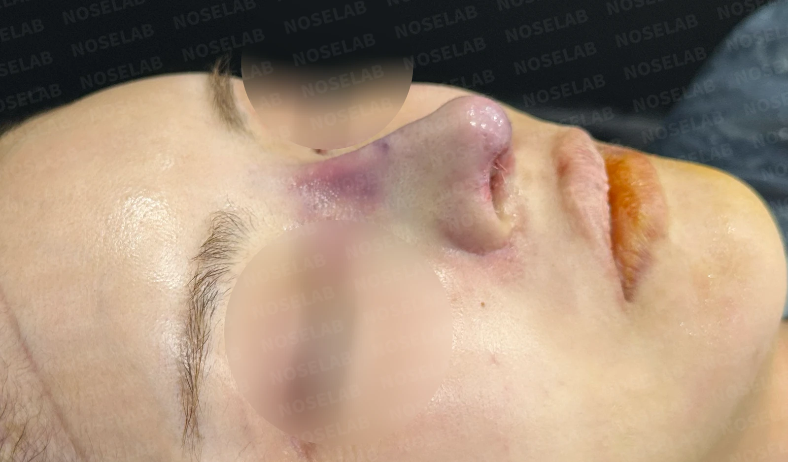 들린코, 휜코 교정 코성형 사례 — 전(좌) 직후(우)