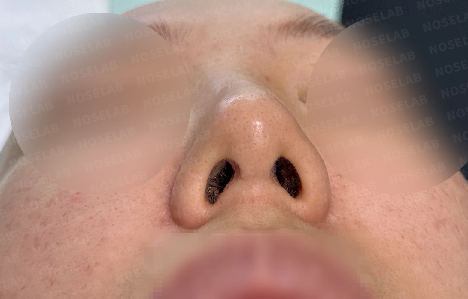 반복 수술 후 긴 코와 높은 시작점의 재수술 방법 — 수술 전 / 수술 직후 0일 직후 사진은 부기가 있는 상태로 최종 결과와 다를 수 있습니다.