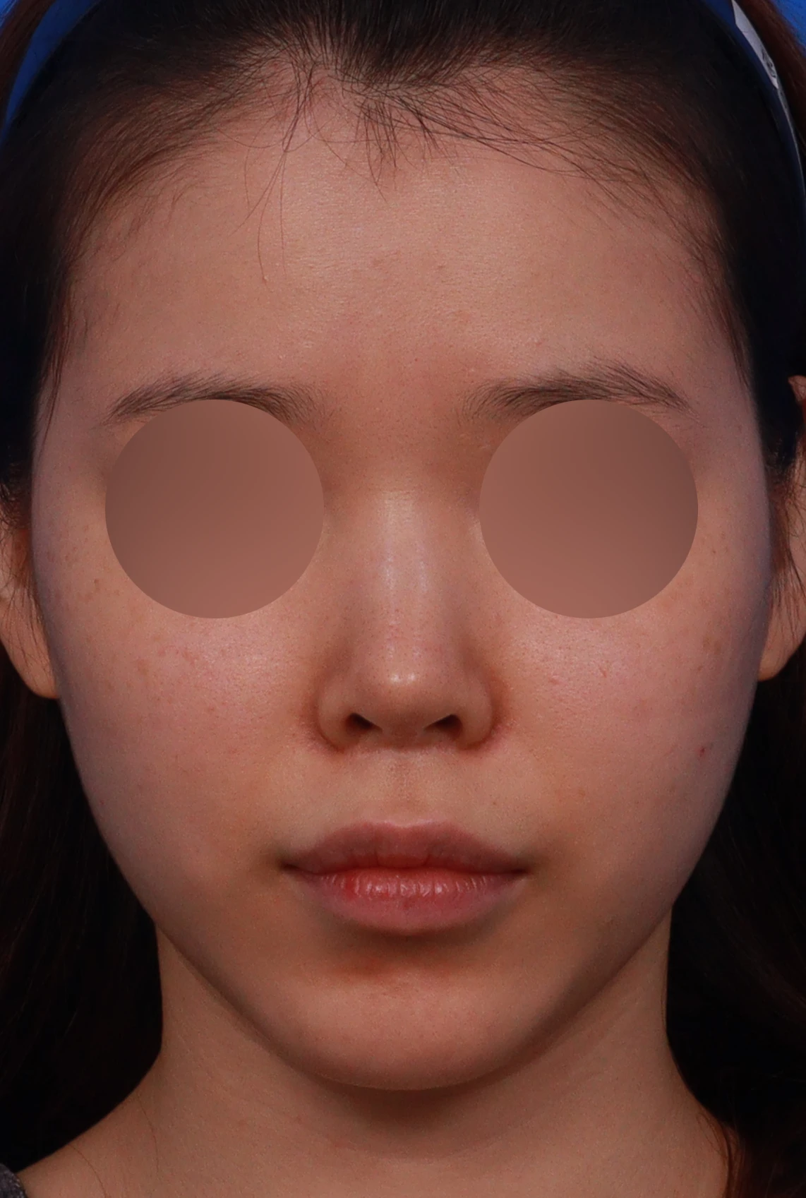 귀연골만으로 코끝을 받쳤을 때 생기는 변화와 늑연골 재건 방법 — 디자인 상담 정면, 비스듬한 측면, 좌측 측면 사진입니다.