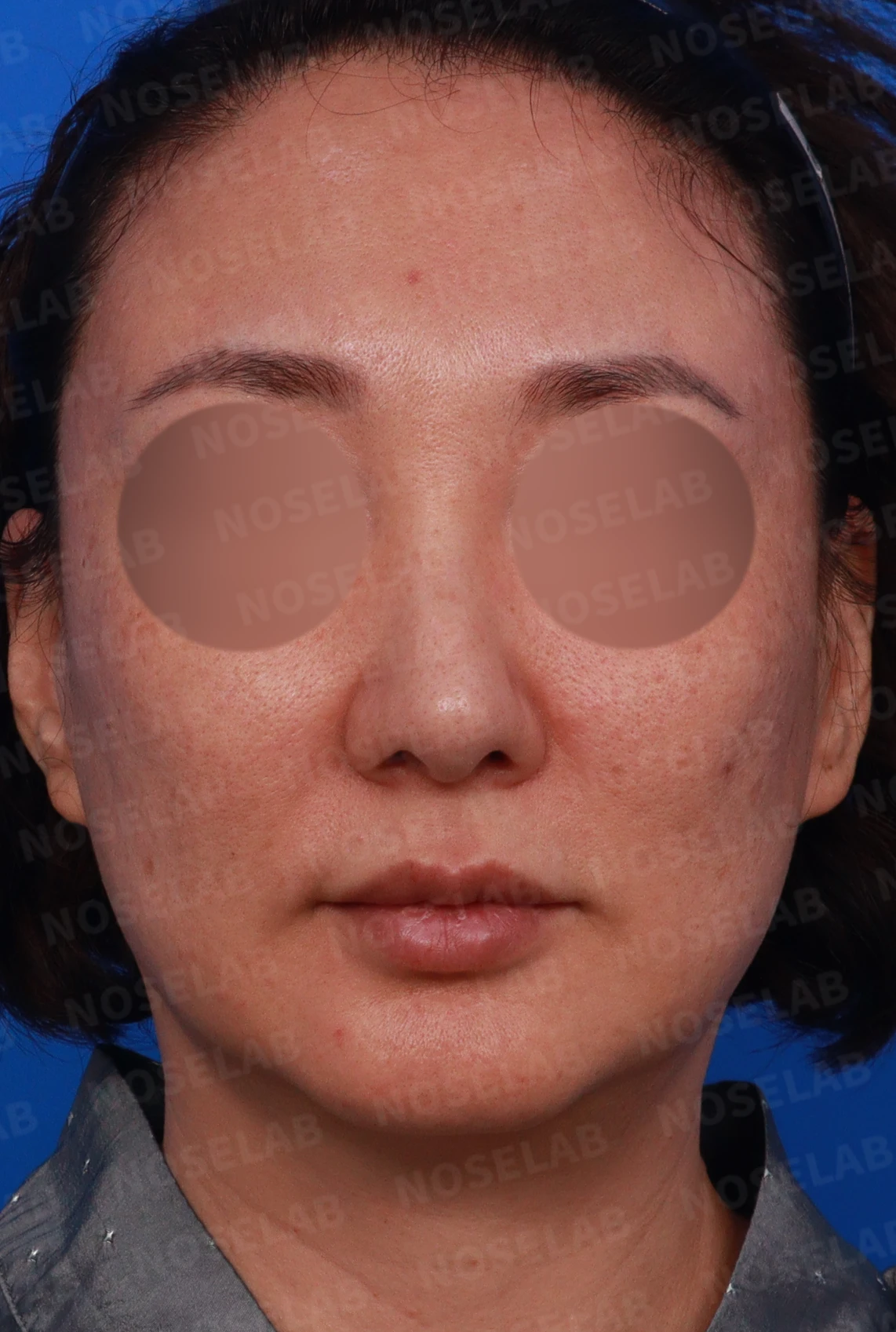 매부리 교정을 받은 코가 다시 휘어 보이는 이유와 절골 재교정 방법 — 디자인 상담 정면, 좌측 측면, 비스듬한 측면 사진