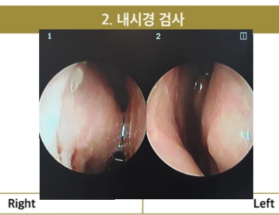 짧고 들린 코를 교정하는 재수술 방법 — 내시경 사진
