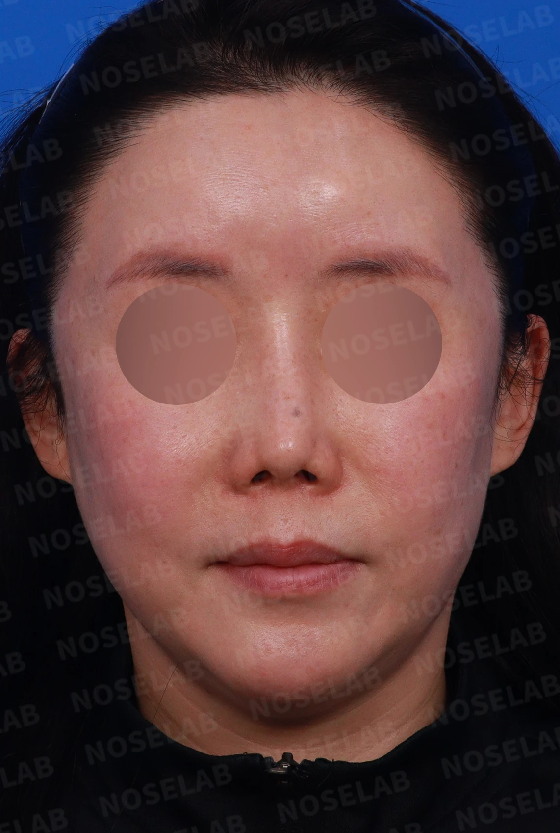 귀족수술 보형물이 코 안으로 밀려 나와 숨이 막히는 이유와 재건 방법 — 디자인 상담 정면, 좌측 , 비스듬한 측면 , 측면 사진입니다.