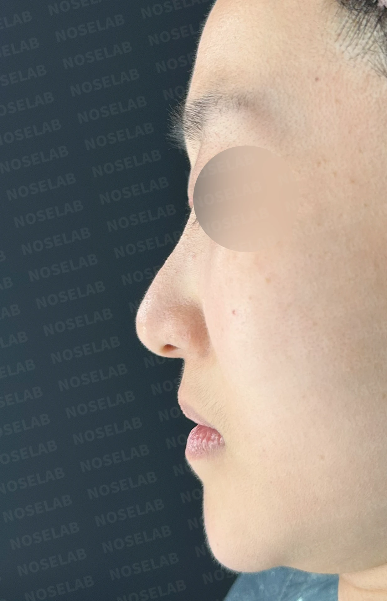 코가 한쪽으로 휘어 보이고 밤에 막히는 이유, 비중격 재건과 코막힘 개선 — 본문 사진 9