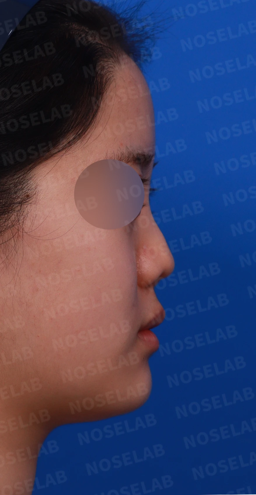 이전 수술 뒤 콧구멍이 좁아지는 비공협착, 원인과 재건 방법 — 디자인 상담 우측 측면, 비스듬한 측면, 비공 사진입니다.
