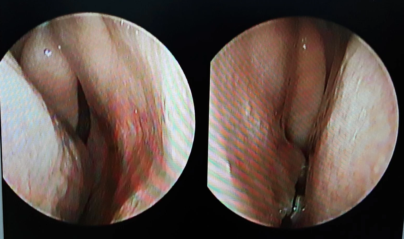 코끝이 찝히고 비주가 함몰되는 이유, 메드포어 제거와 재건은 어떻게 하나 — 본문 사진 7