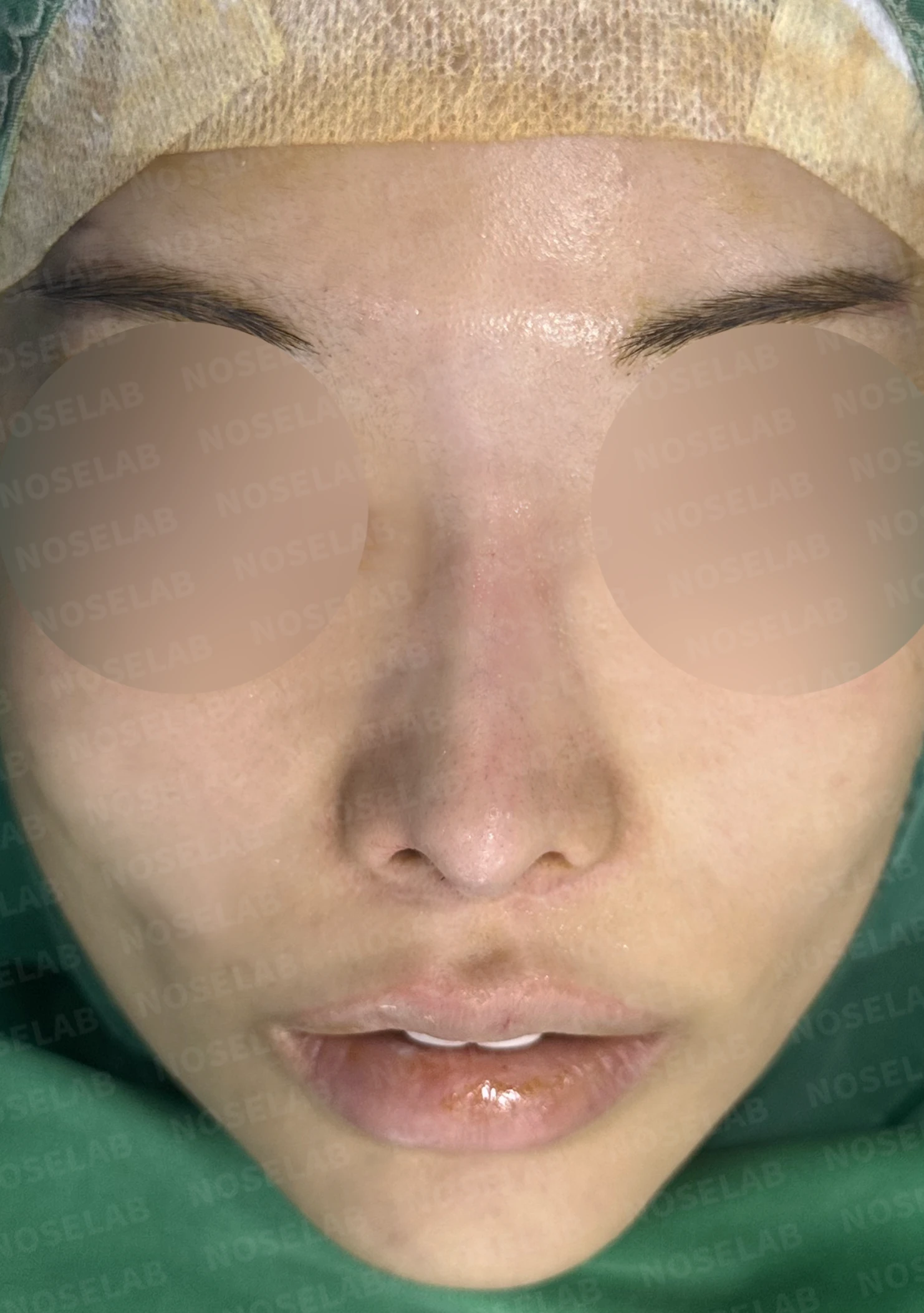 콧대 반영구 필러가 남기는 변화와 제거 후 비중격 재건 — 수술 직후 0일 정면, 비스듬한 측면, 측면 사진입니다. 직후 사진은 부기가 있는 상태로 최종 결과와 다를 수 있습니다.