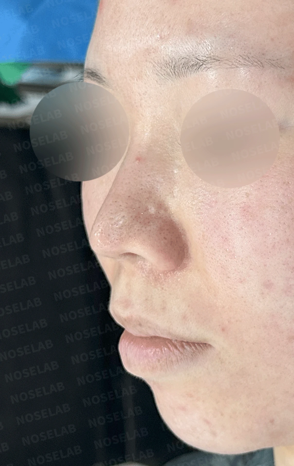 콧구멍을 막는 종괴가 생기는 이유, 제거와 재건은 어떻게 하나 — 본문 사진 19