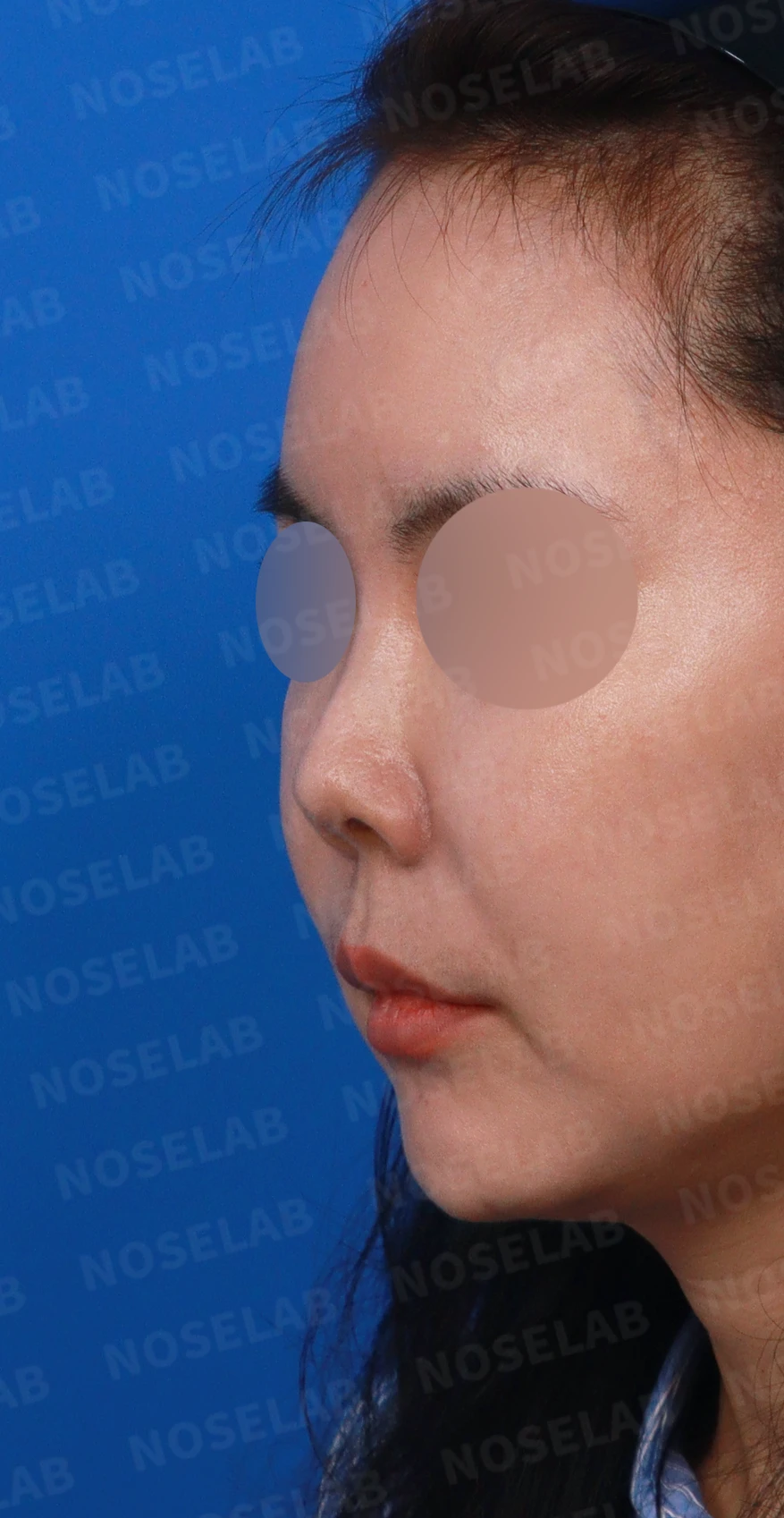 L자 실리콘 보형물이 비주 점막을 뚫기 직전까지 가는 이유, 제거와 자가늑연골 재건 방법 — 디자인 상담 정면, 좌측 측면, 비스듬한 측면 사진