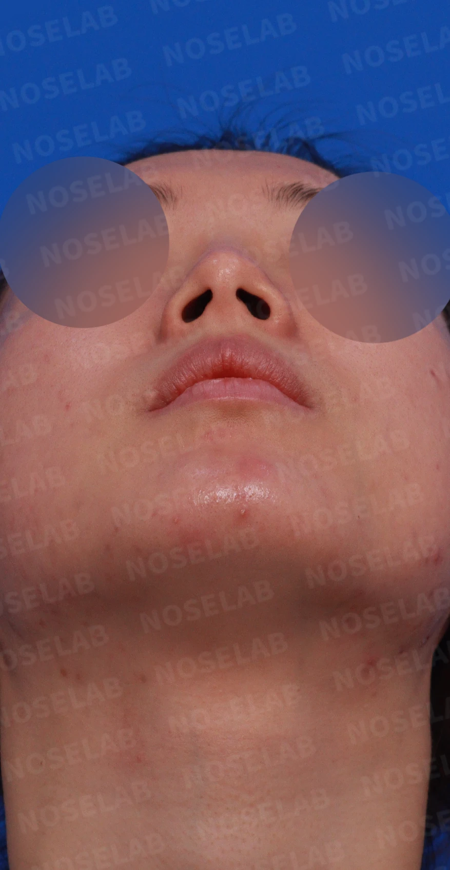 코 필러 뒤에도 휜 코와 코막힘이 남는 이유, 교정은 어떻게 하나 — 디자인 상담 우측 측면, 비스듬한 측면, 비공 사진