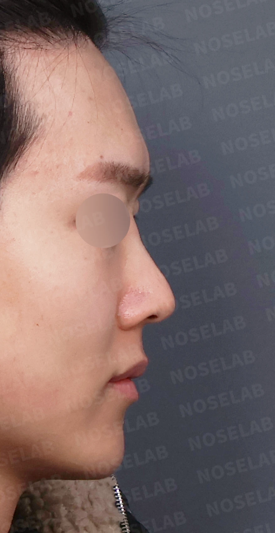 코가 낮아 보이는 이유와 자가 늑연골로 높이를 만드는 방법 — 디자인 상담 우측 측면, 비스듬한 측면, 비공 사진입니다.