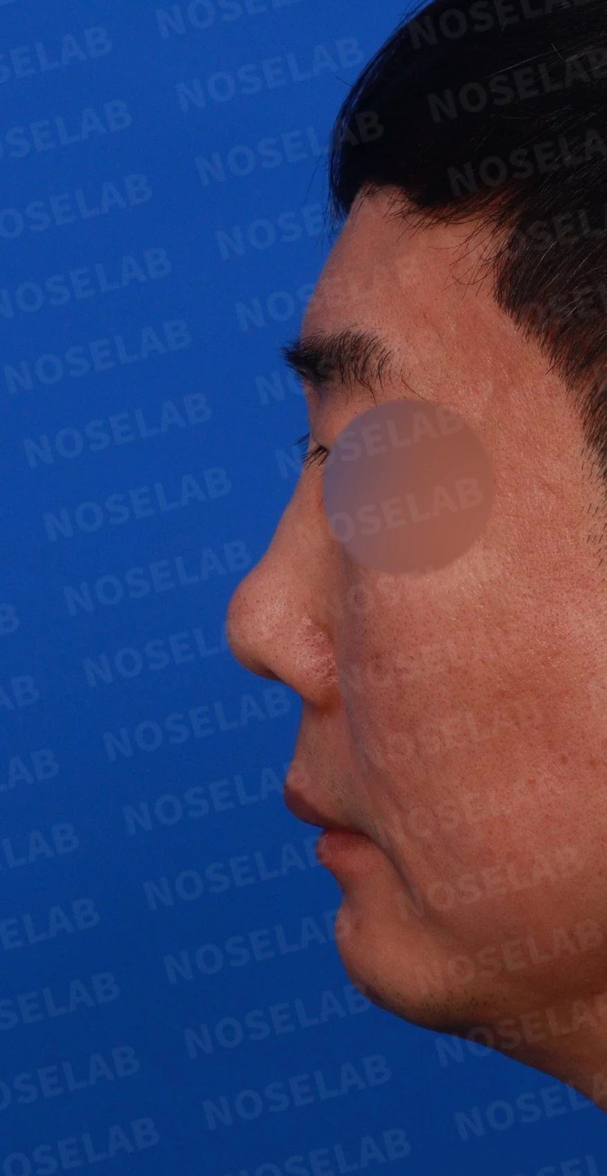 매부리코 수술 후 비대칭의 재수술 방법 — 디자인 상담 정면, 좌측 측면, 비스듬한 측면 사진