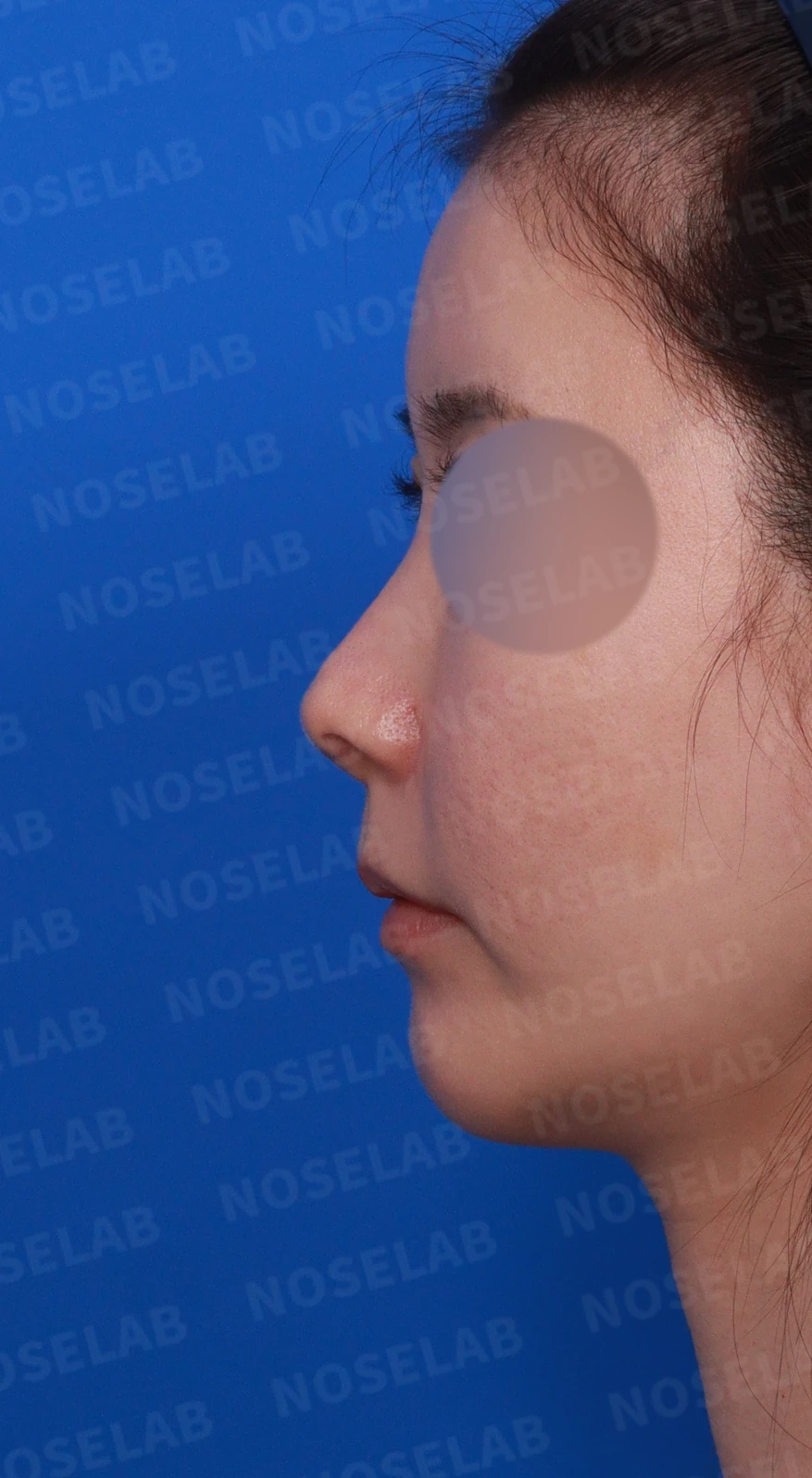 코성형 후 남는 미세한 높이 부족과 좌우 비대칭, 왜 생기고 어떻게 보강하나 — 디자인 상담 정면 , 좌측 측면 , 비스듬한 측면 사진입니다.