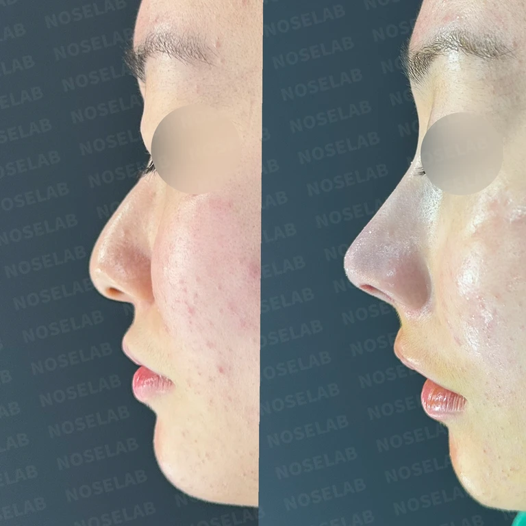 코끝이 뭉툭하게 퍼지고 코가 휘어 보이는 이유, 늑연골 재건은 어떻게 하나 — 전후 비교