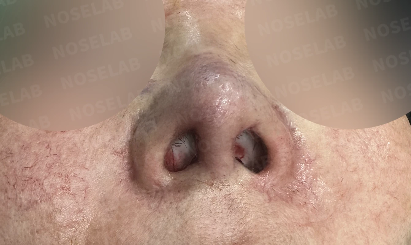 보형물 염증으로 손상된 코, 휴식기 후 기증늑연골로 안전하게 재건한 코재수술 — 전(좌) 직후(후)