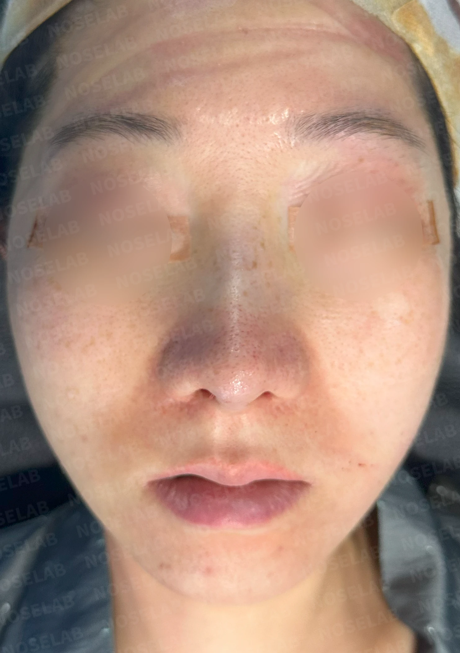 콧대 시작점이 높고 코가 휘어 보이는 이유, 자가 늑연골 교정은 어떻게 하나 — 수술 직후 0일 정면 , 비스듬한 측면 , 측면 사진입니다. 직후 사진은 부기가 있는 상태로 최종 결과와 다를 수 있습니다.