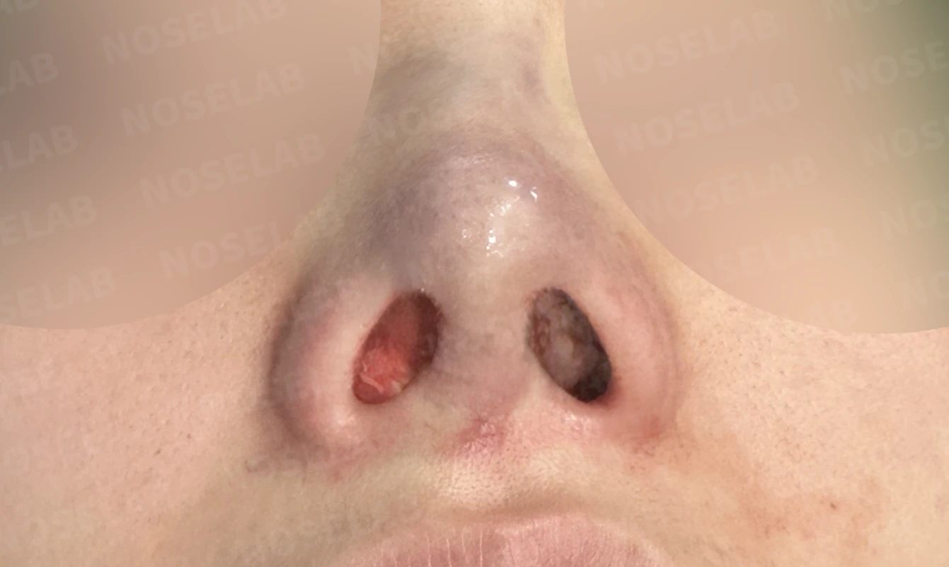보형물 비침과 비대칭, 자가늑연골 코재수술로 자연스럽게 교정한 사례 — 직후 비공 사진