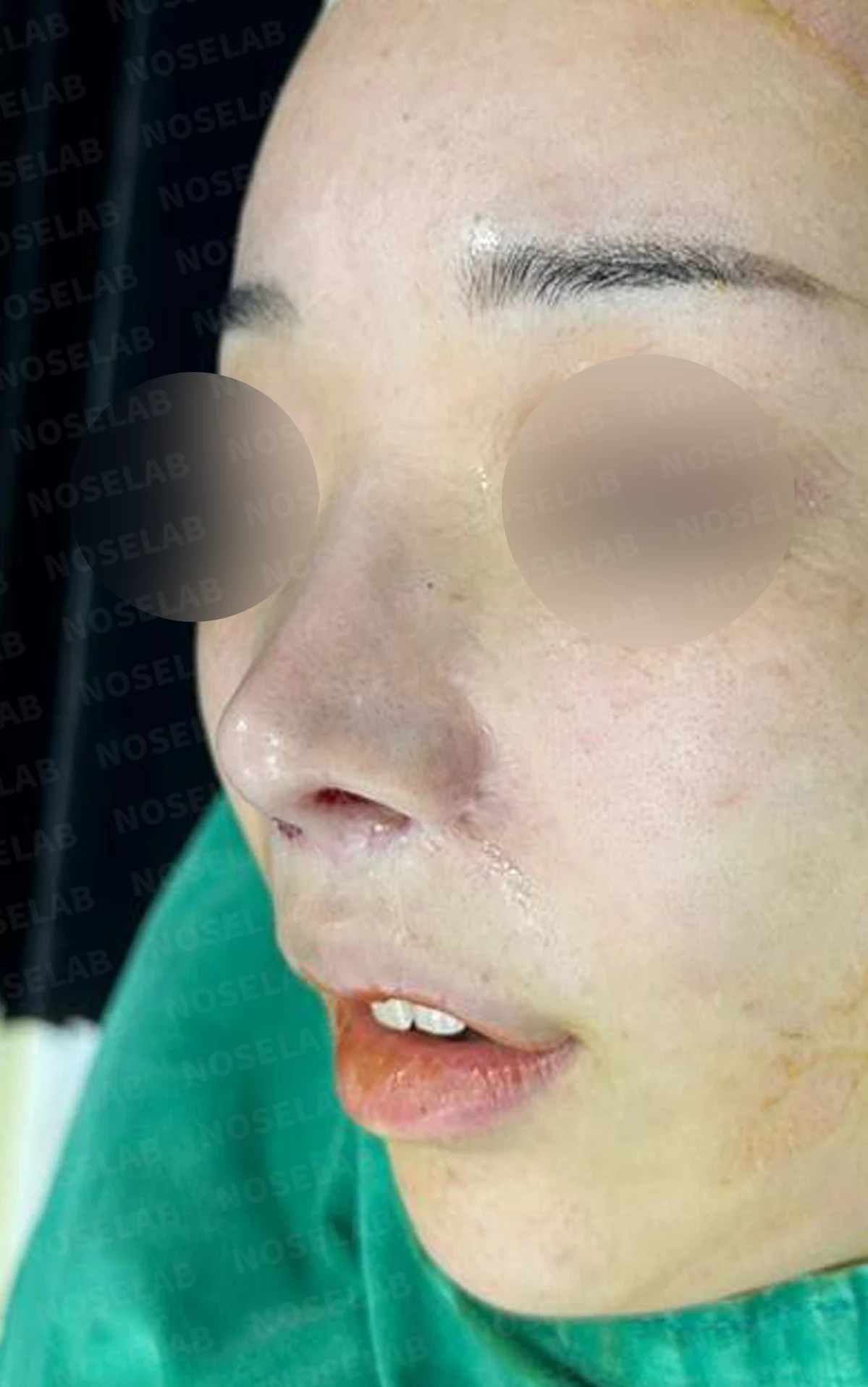 콧구멍 비대칭과 협착이 생기는 이유, 늑연골 재건과 Z성형은 어떻게 하나 — 수술 전 / 수술 직후 0일 직후 사진은 부기가 있는 상태로 최종 결과와 다를 수 있습니다.