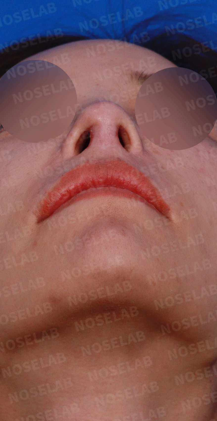 두꺼운 비주와 들린 코끝이 생기는 이유, 자가 늑연골 재건은 어떻게 하나 — 디자인 상담 비공, 우측 측면, 비스듬한 측면 사진입니다.