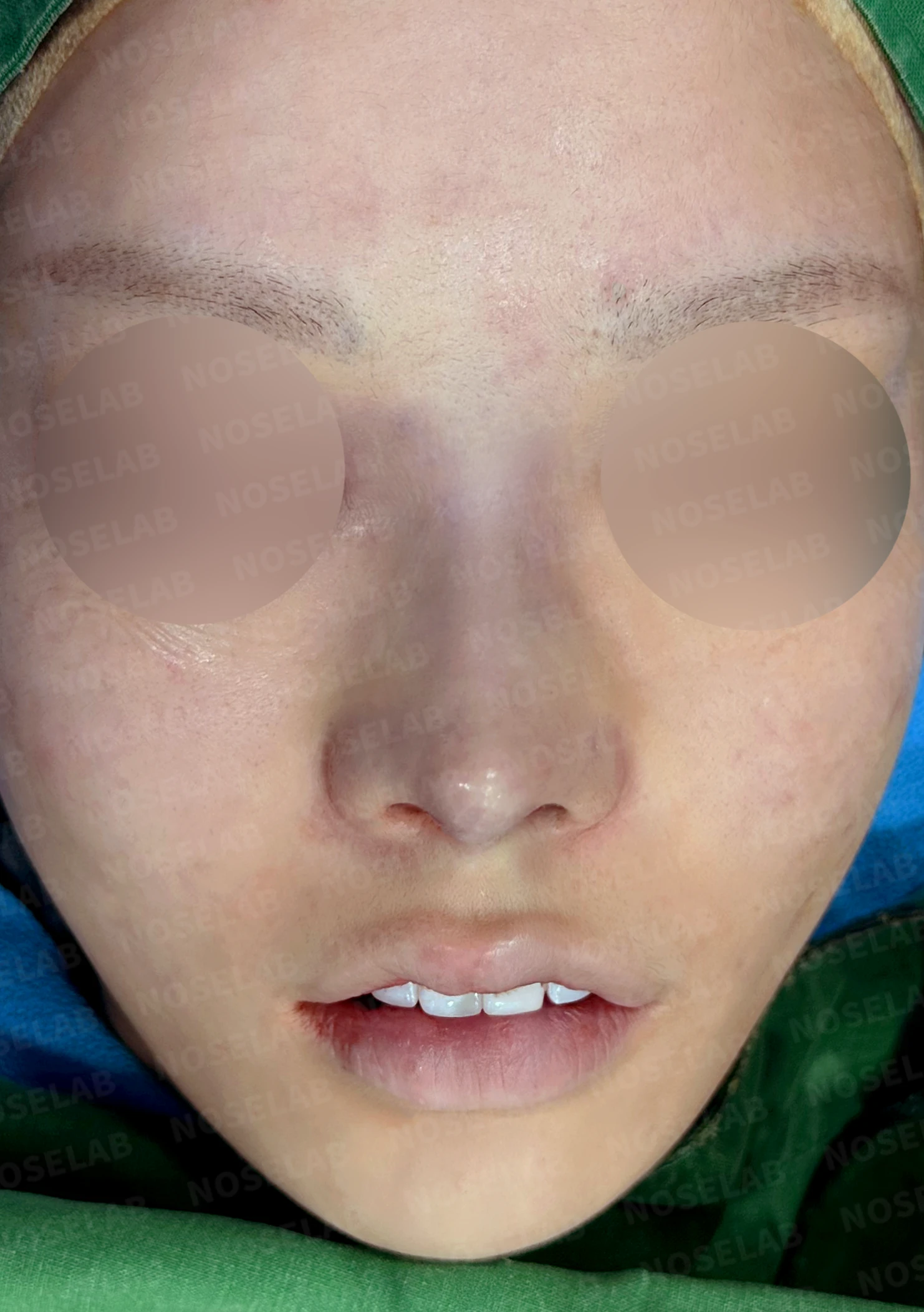 심한 비중격 만곡과 높은 콧대 시작점, 기증늑연골로 정밀 재건 — 전(좌) 직후(후)