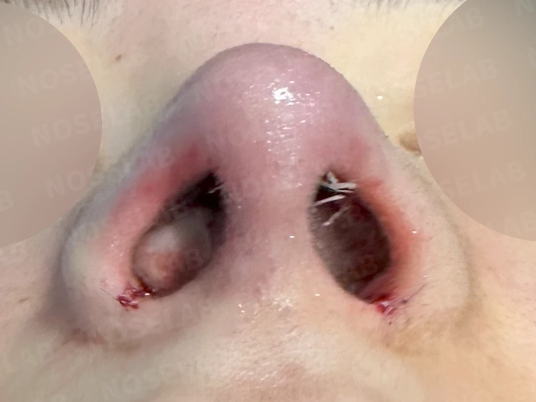 여러 코 모양 고민을 함께 살펴보는 코성형 계획 — 콧구멍 사진입니다.
