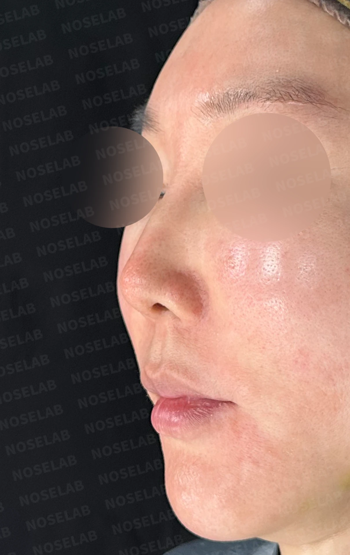 매부리를 깎은 뒤 다시 매부리가 보이고 콧구멍이 드러나는 이유 — 수술 전 / 수술 직후 0일 직후 사진은 부기가 있는 상태로 최종 결과와 다를 수 있습니다.