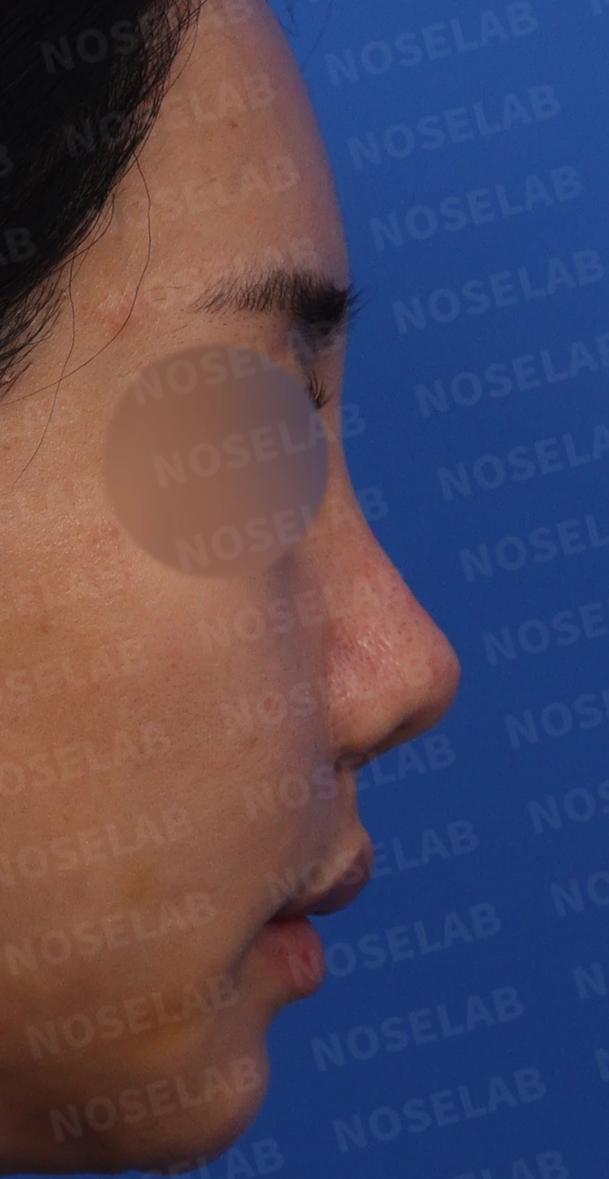 복코·휜코·들린코 교정 방법 — 측면 사진