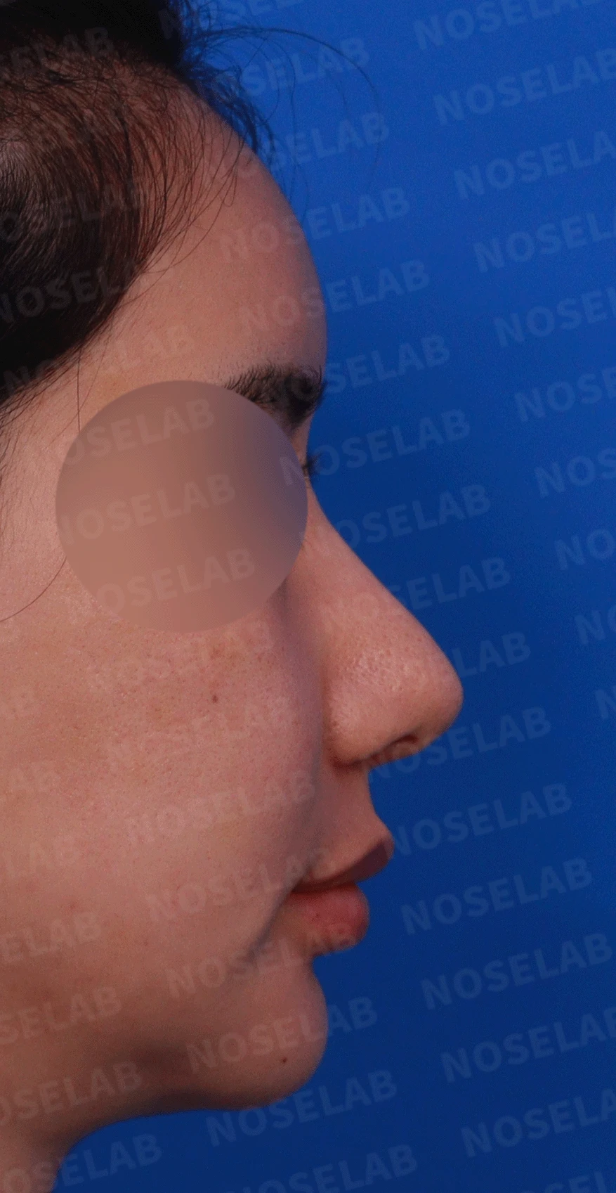 코가 과하게 높아져 부자연스러워 보이고 휘는 이유, 재건은 어떻게 하나 — 디자인 상담 우측 비스듬한 측면 , 측면 , 비공 사진입니다.