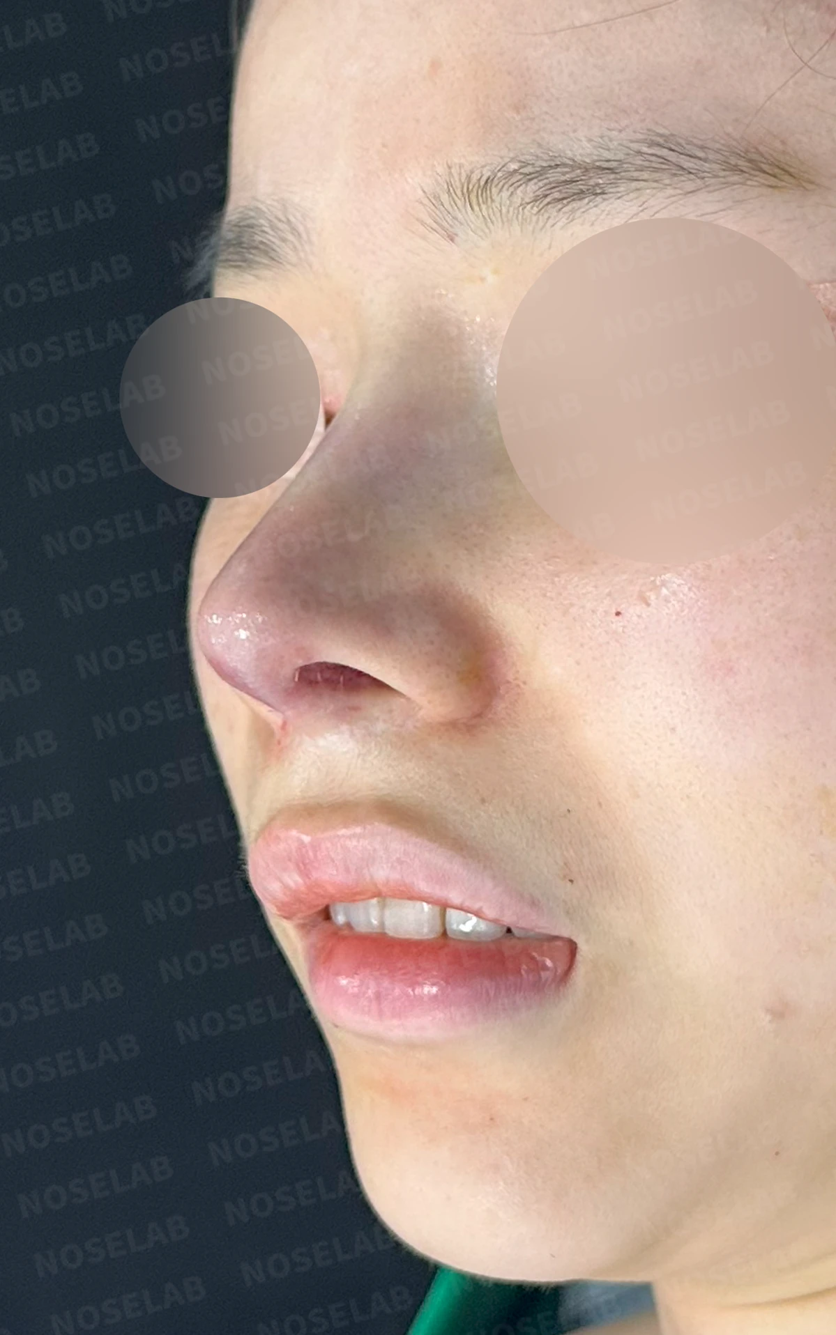 귀연골만으로 코끝을 받쳤을 때 생기는 변화와 늑연골 재건 방법 — 수술 직후 0일 정면, 비스듬한 측면, 측면 사진 직후 사진은 부기가 있는 상태로 최종 결과와 다를 수 있습니다.