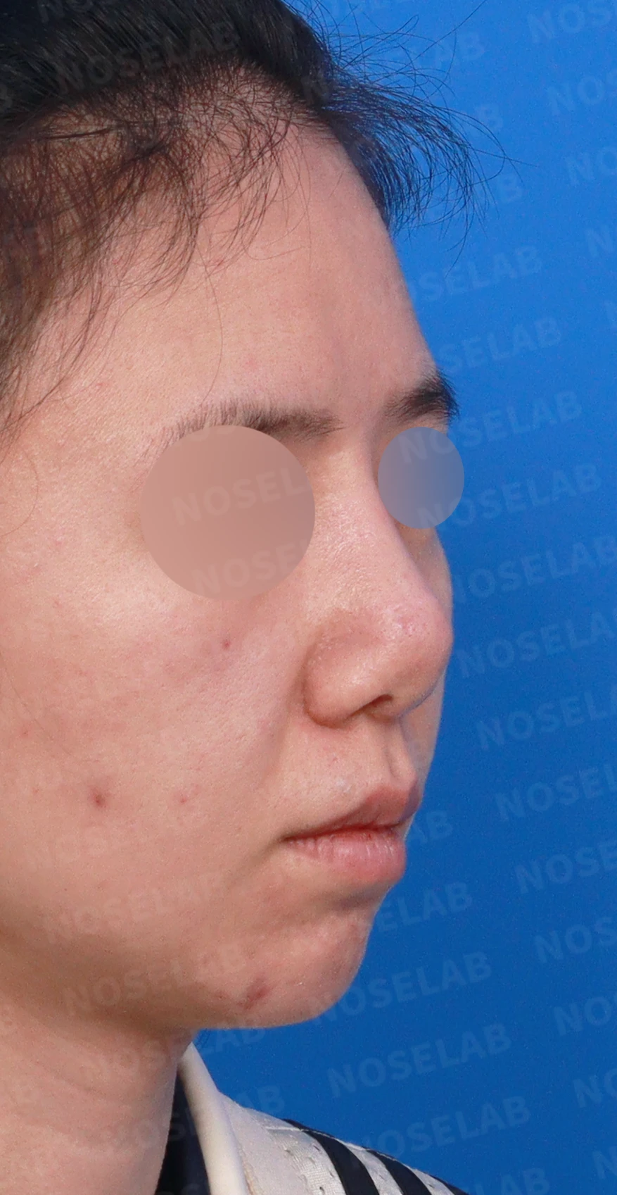 이전 수술 뒤 코가 딱딱해지고 짧아지는 구축, 왜 생기고 어떻게 재건하나 — 디자인 상담 우측 측면, 비스듬한 측면, 비공 사진입니다.