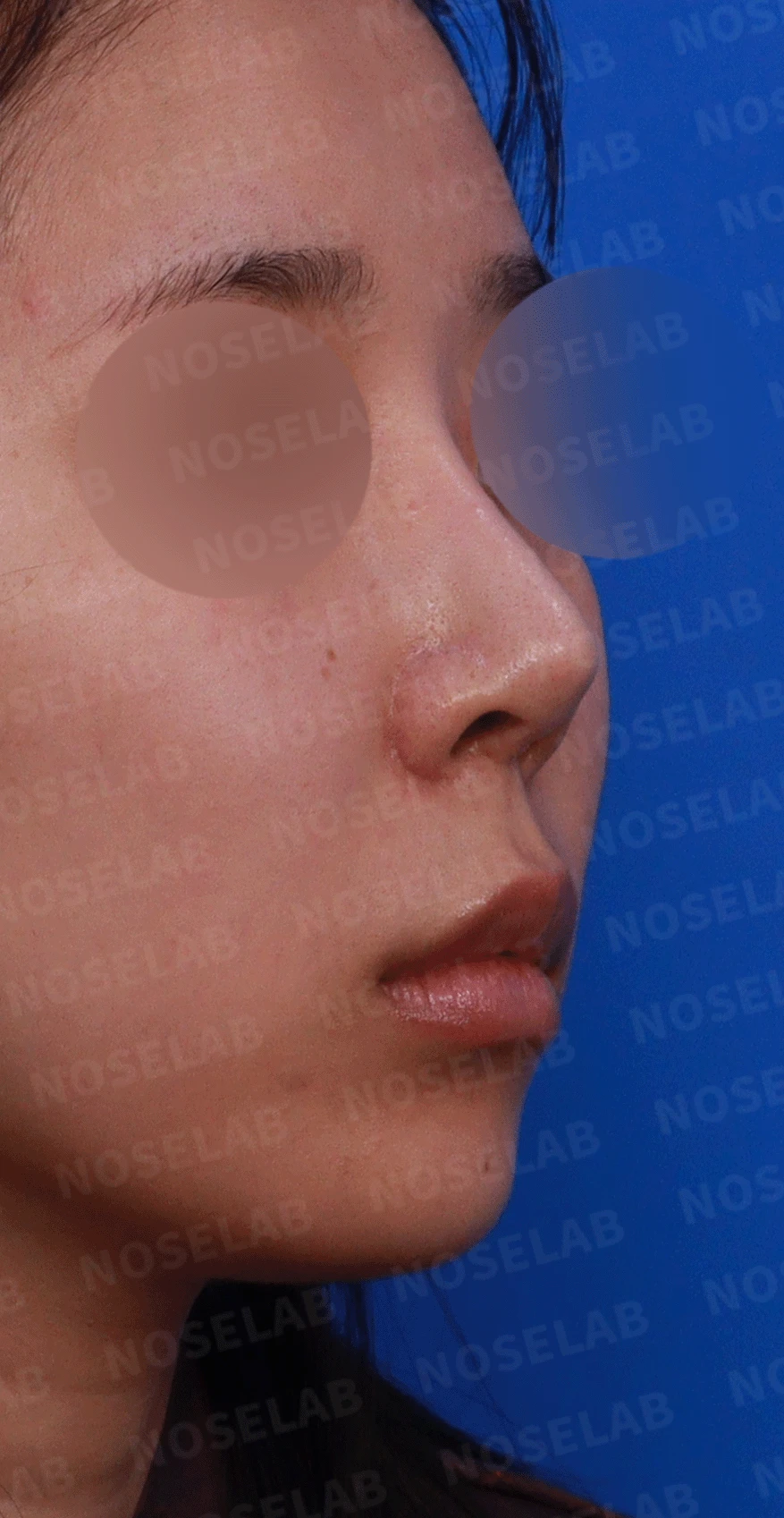 여러 번 수술한 코에 연골이 비치는 이유와 점막·구조 복원 방법 — 디자인 상담 우측 측면 , 비스듬한 측면 , 비공 사진입니다.
