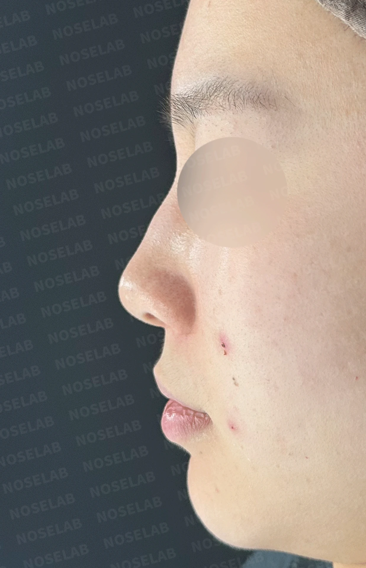 복코가 잘 교정되지 않는 이유와 이물질 제거 후 재건 방법 — 본문 사진 9