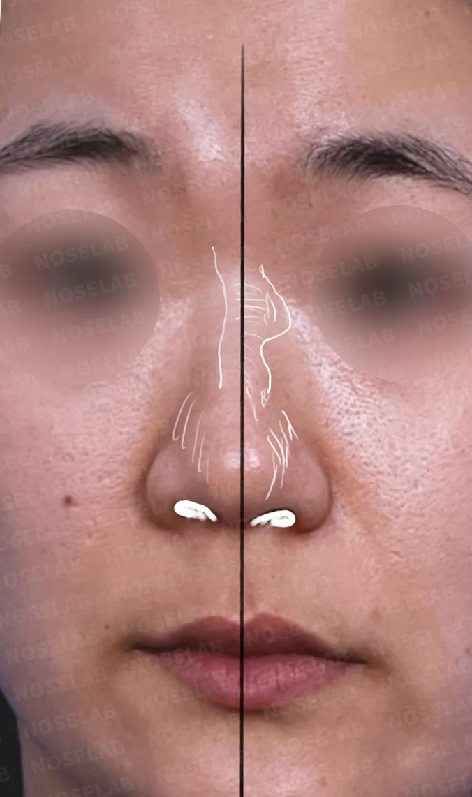 복코 수술은 어떻게 하나요? — 수술전 디자인 상담때 찍은 정면사진입니다.