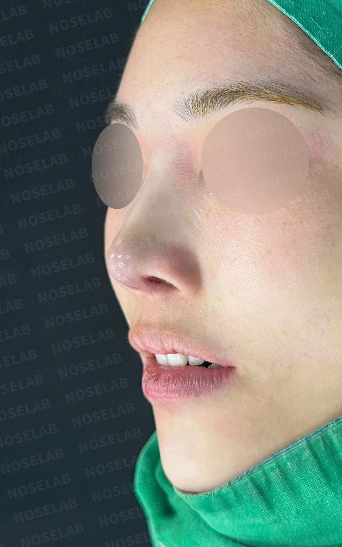 보형물을 넣고 빼기를 반복한 코에 남는 콧등 패임과 들린 느낌 — 수술 전 / 수술 직후 0일 직후 사진은 부기가 있는 상태로 최종 결과와 다를 수 있습니다.