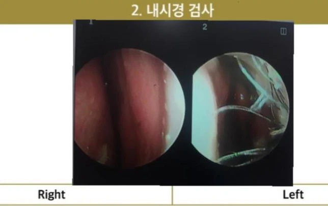 들린 코에서 콧구멍이 삼각형으로 드러나는 이유, 비공 모양 교정은 어떻게 하나 — 코 내시경 사진