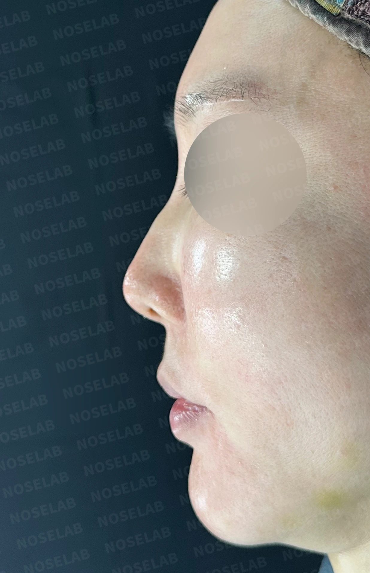 매부리를 깎은 뒤 다시 매부리가 보이고 콧구멍이 드러나는 이유 — 수술 전 / 수술 직후 0일 직후 사진은 부기가 있는 상태로 최종 결과와 다를 수 있습니다.