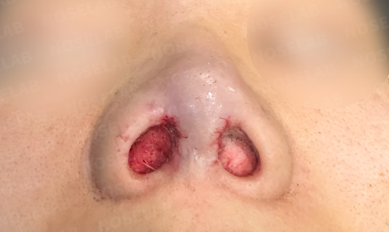 코성형 뒤 감염이 반복되는 이유, 염증 치료와 단계적 재건은 어떻게 하나 — 수술 직후 0일 비공 사진입니다. 직후 사진은 부기가 있는 상태로 최종 결과와 다를 수 있습니다.
