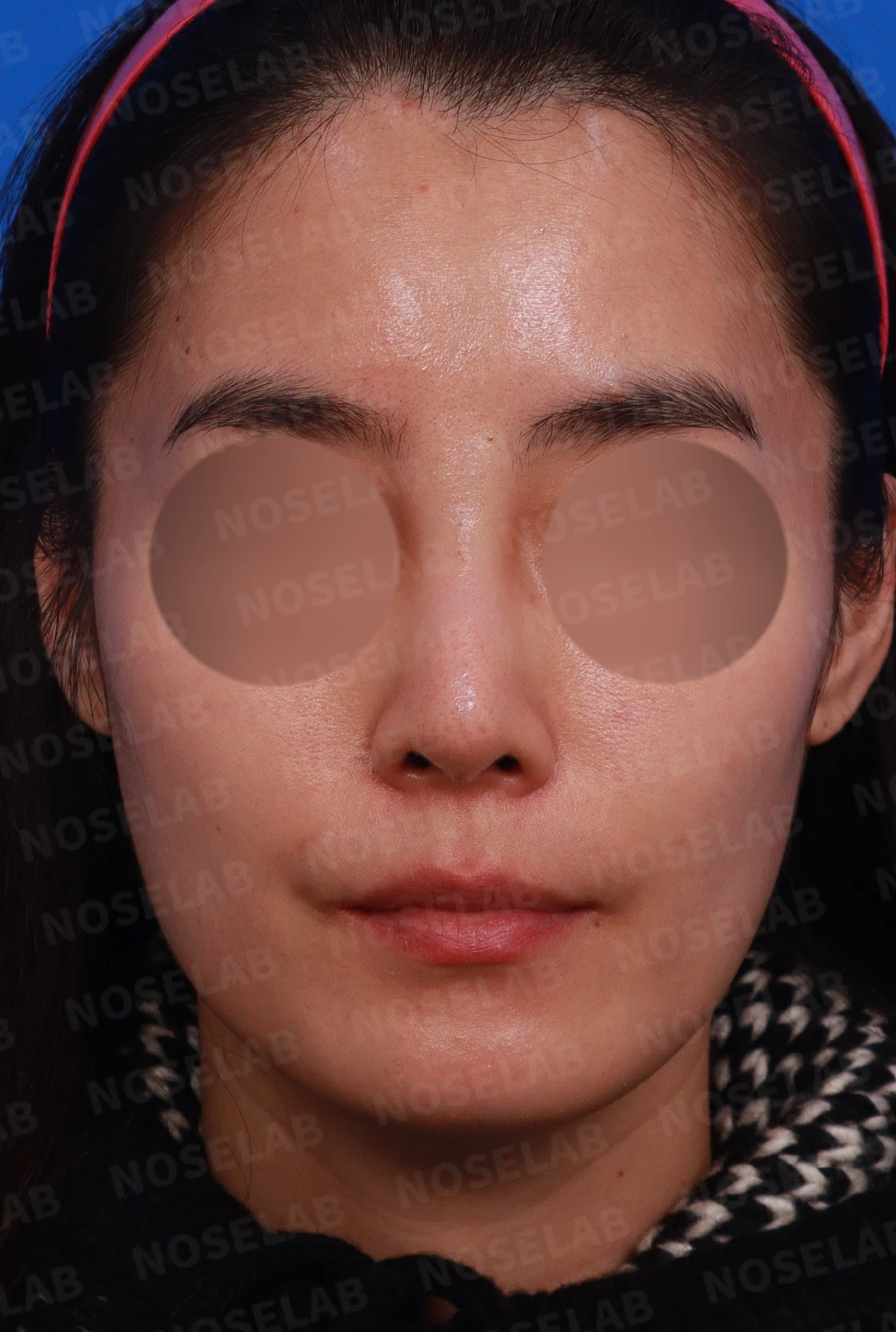 여러 차례 받은 코필러가 남긴 퍼진 코와 코막힘, 어떻게 정리하나 — 디자인 상담 정면, 좌측 측면, 비스듬한 측면 사진