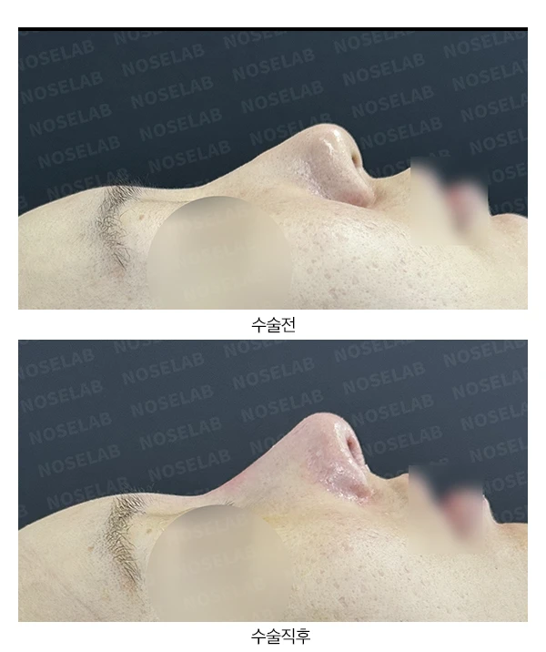 반복 수술 후 긴 코와 높은 시작점의 재수술 방법 — 본문 사진 17