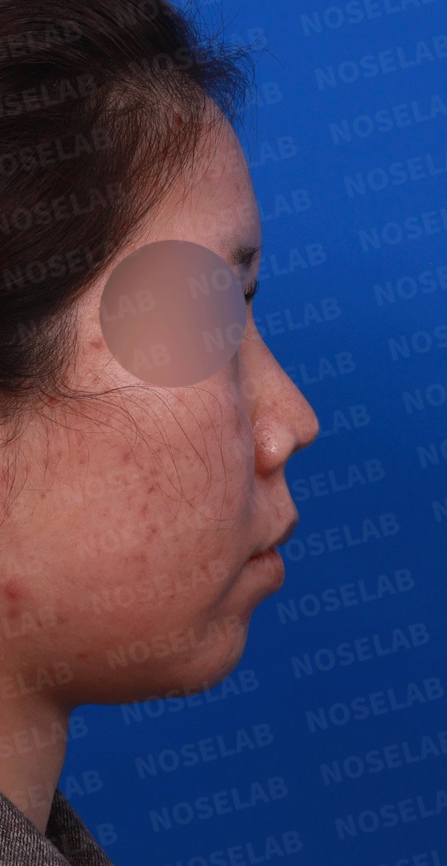 콧구멍을 막는 종괴가 생기는 이유, 제거와 재건은 어떻게 하나 — 디자인 상담 우측 비스듬한 측면 , 측면 , 비공 사진입니다.