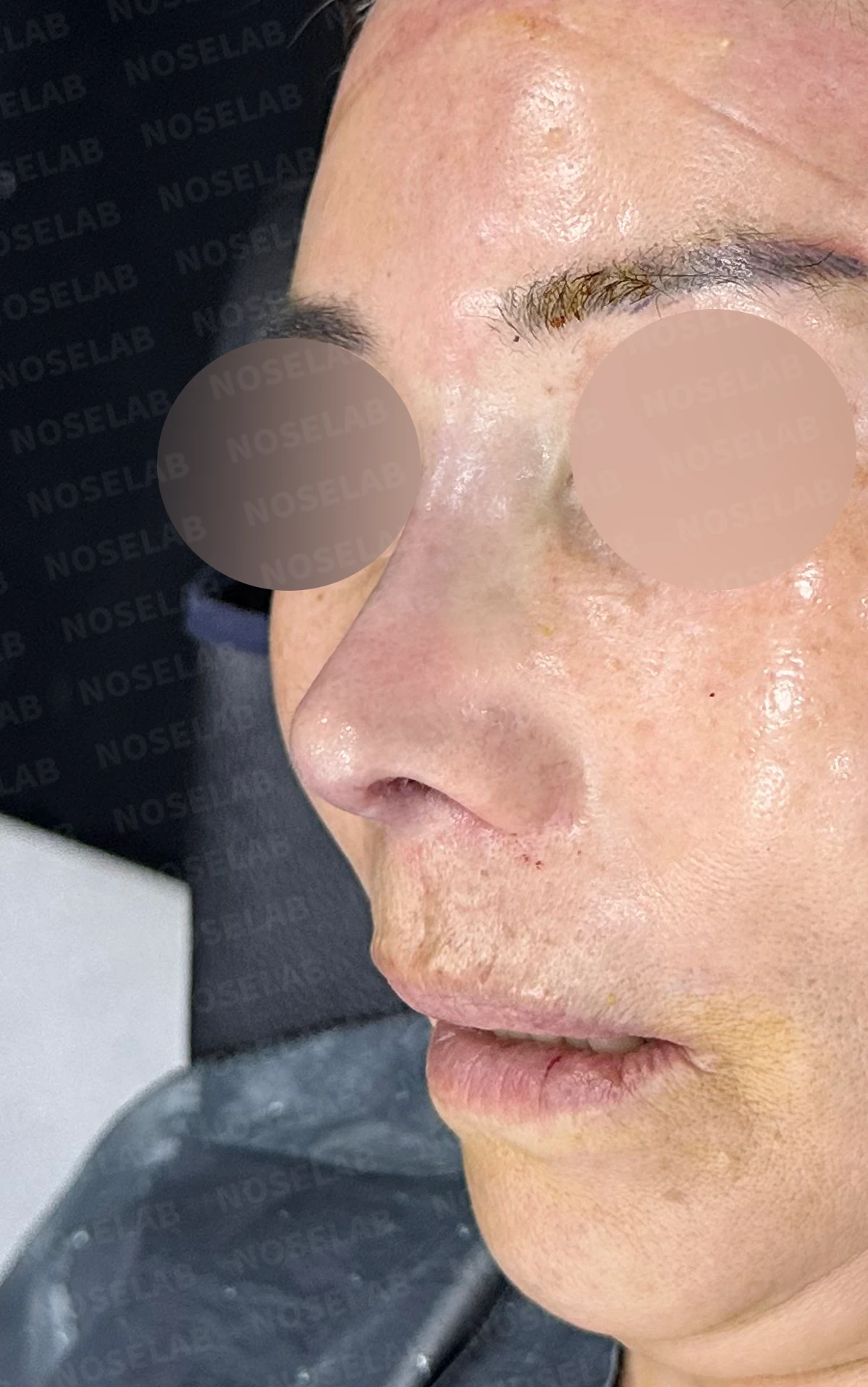 오래된 실리콘 보형물이 변형과 통증을 일으키는 이유, 늑연골 재건은 어떻게 하나 — 수술 전 / 수술 직후 0일 직후 사진은 부기가 있는 상태로 최종 결과와 다를 수 있습니다.