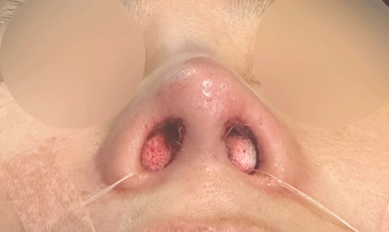 오래된 실리콘이 코끝에서 비쳐 보이는 이유와 제거·재건 방법 — 본문 사진 14